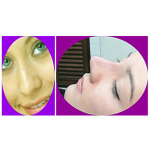 เสริมจมูก - เพชรรัตน์คลีนิค